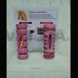 ASTHMA MODEL